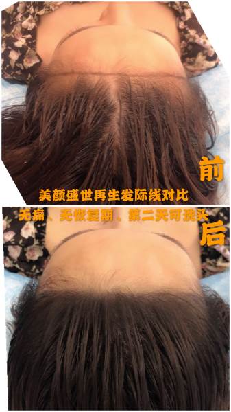 再生发效果展示五